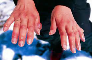 Image Example for frostbite