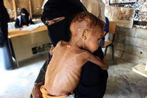 Image Example for malnutrition