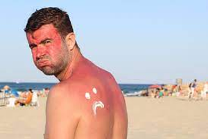 Image Example for sunburned