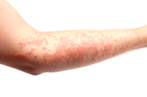 Image Example for rash
