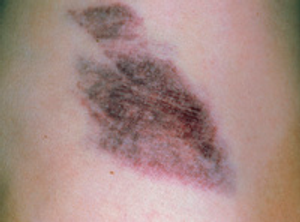 Image Example for bruise