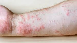 Image Example for rash