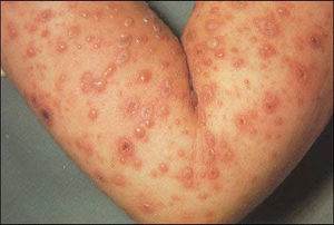 Image Example for chickenpox