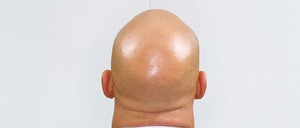Image Example for bald