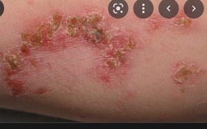 Image Example for infection
