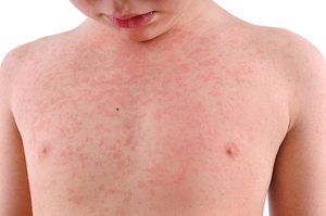 Image Example for allergy