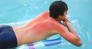 Image Example for get sunburn