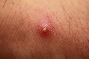 Image Example for pimple