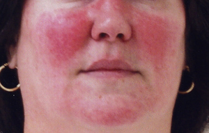 Image Example for skin condition