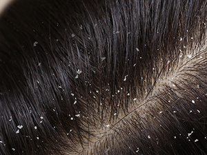 Image Example for dandruff