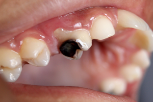 Image Example for tooth decay