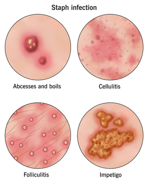 Image Example for infection