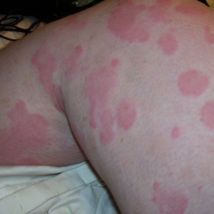 Image Example for rash