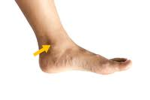 Image Example for ankle