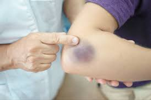 Image Example for bruise