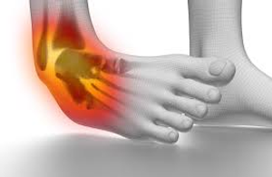 Image Example for sprain