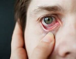 Image Example for itchy eyes