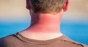 Image Example for get burnt